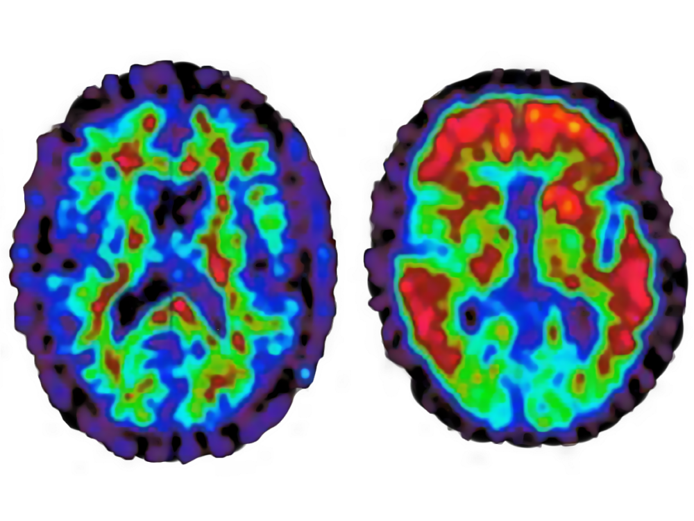 These brain images are for demonstration purposes only and not images from the NeuroLF system