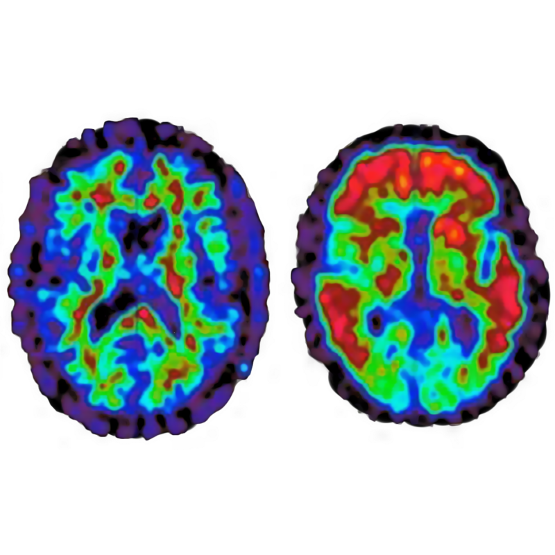 These brain images are for demonstration purposes only and not images from the NeuroLF system